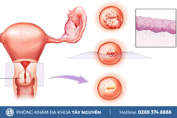 Tác hại của viêm lộ tuyến cổ tử cung