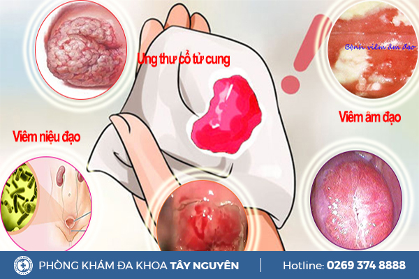 Huyết Trắng Ra Nhiều Dấu Hiệu Cảnh Báo Bệnh Phụ Khoa Nguy Hiểm