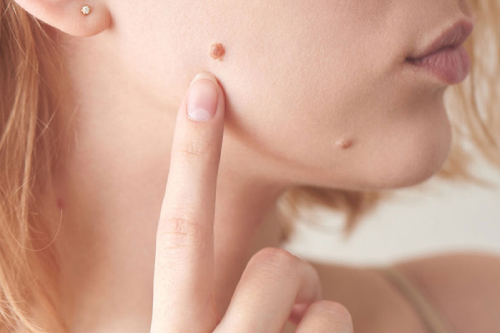 Mụn Hạt Cơm: Nguyên Nhân Và Cách Điều Trị Mụn Hạt Cơm: Nguyên Nhân Và Cách Điều Trị