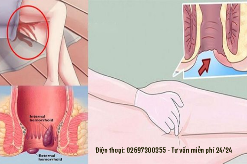 Sùi Mào Gà Âm Đạo Nguy Hiểm Như Thế Nào Đối Với Chị Em Phụ Nữ