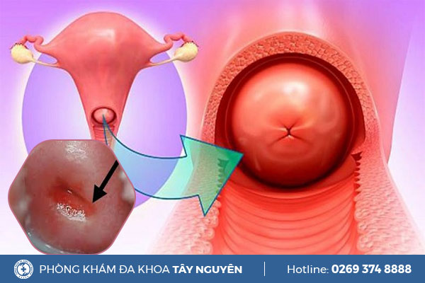 Tình trạng viêm cổ tử cung và cách điều trị hiệu quả