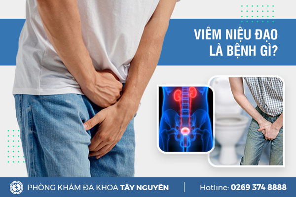 Viêm niệu đạo là bệnh gì Nên điều trị như thế nào để đạt hiệu quả?